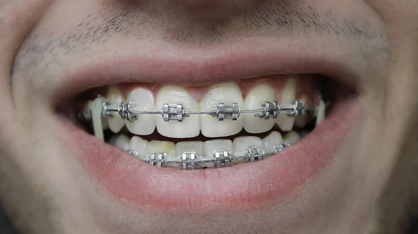 Braces for Adults in Culver City
