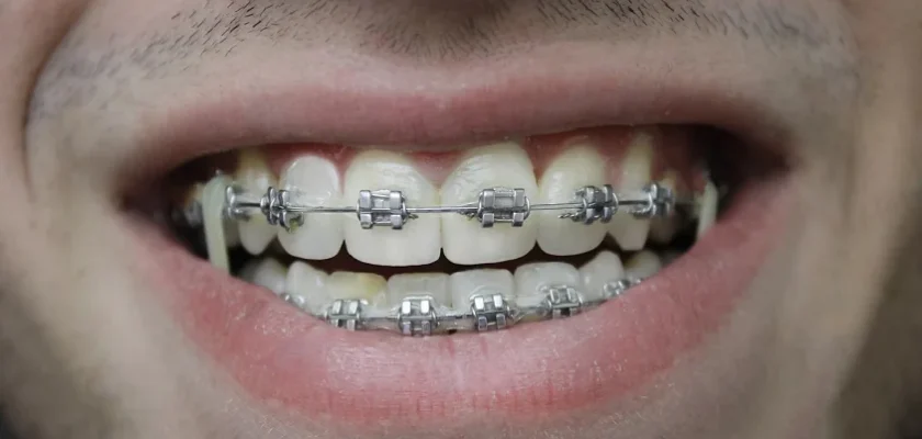 Braces for Adults in Culver City